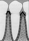 Gingivitia