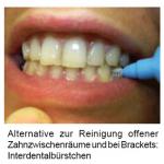 Invisalign